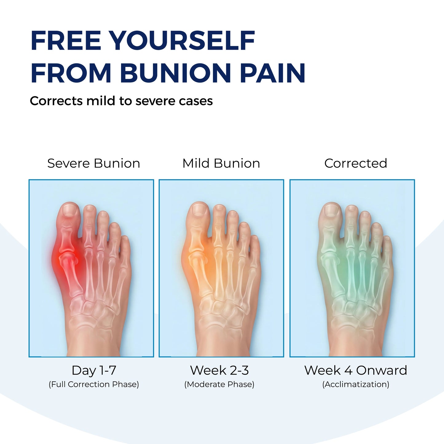 Toe Alignment Corrector – Realign Your Toe