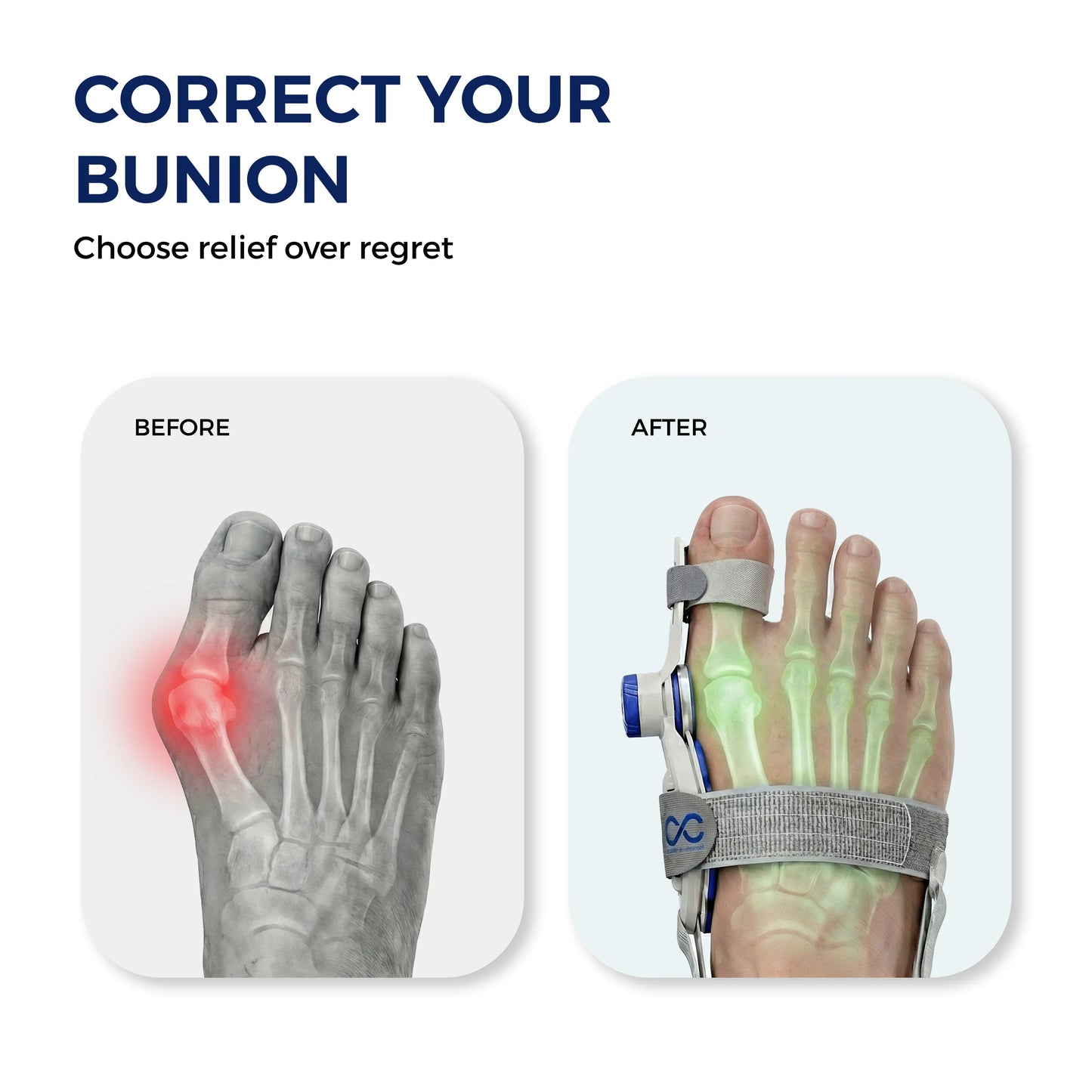 Toe Alignment Corrector – Realign Your Toe