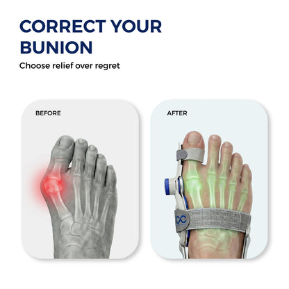 Toe Alignment Corrector – Realign Your Toe